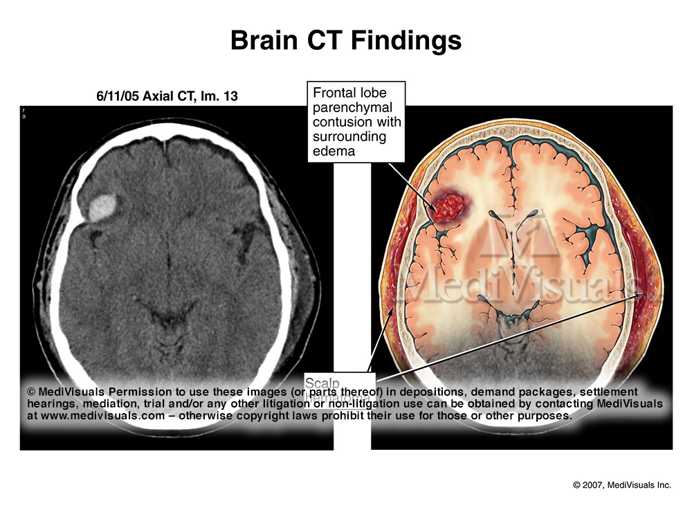 brain contusions ct scan