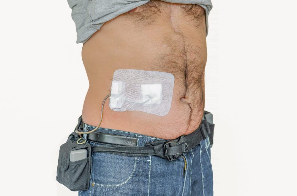 Facts About Medtronic Heartware Ventricular Assist Device (HVAD) Recall ...