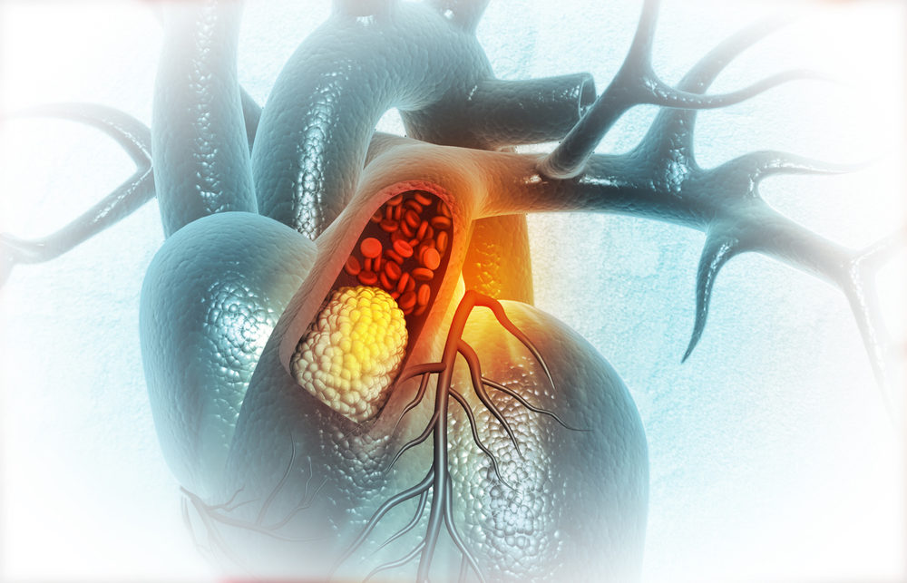 Human heart with clogged arteries. 3d illustration