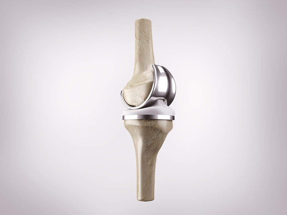 3d rendering of knee replacement