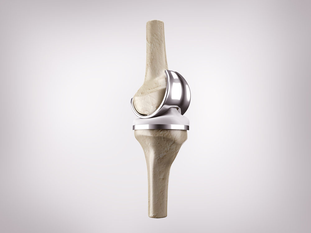 Exactech Truliant Knee Replacement Fails in Just One Year 3d rendering of knee replacement