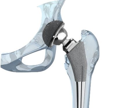 A metal-on-metal hip implant joining leg to pelvis (3d rendering)