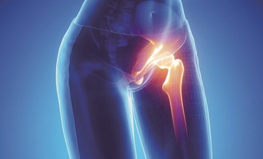 A metal-on-metal hip implant joining leg to pelvis on female x-ray (3d rendering)
