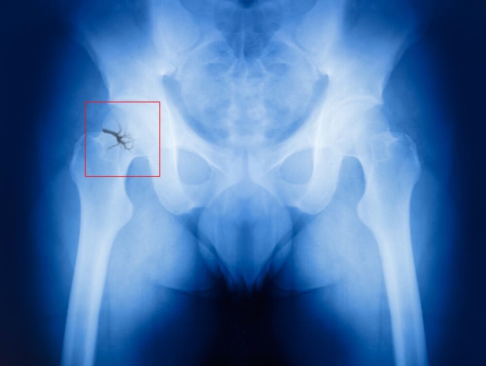 A fractured hip bone as seen on an x-ray