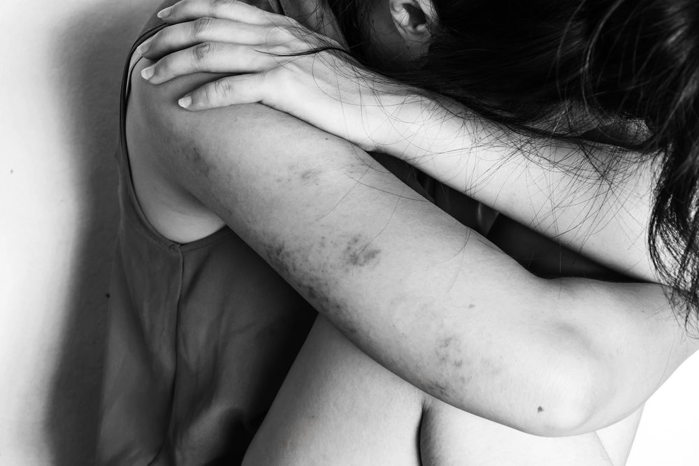 a woman sitting on ground with arm around knee and lower head, bruises on body