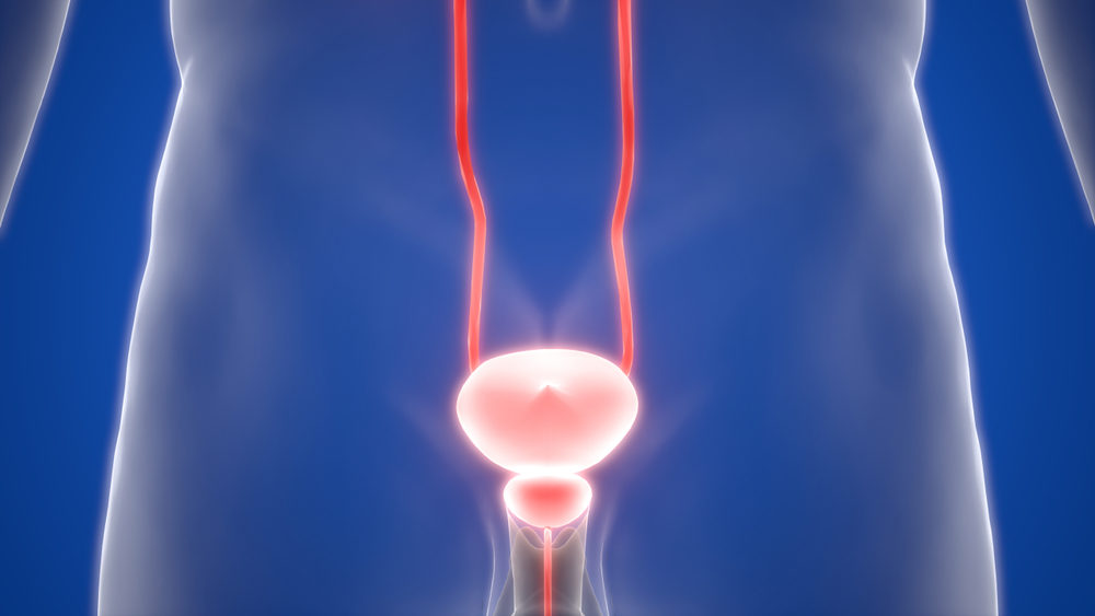 $2.4 billion global settlement to resolve thousands of lawsuits claiming diabetes drug Actos® causes bladder cancer. 3D image of human male urinary bladder organ