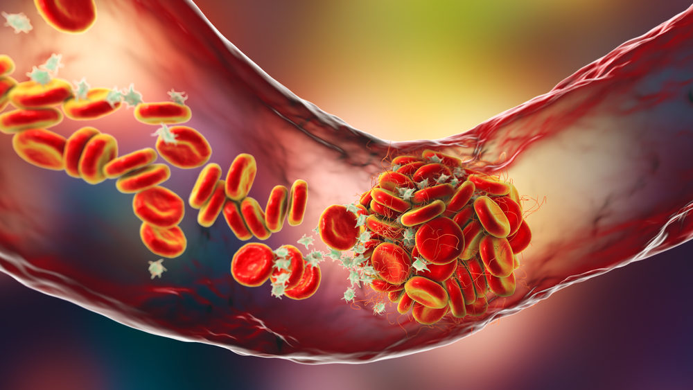 Blood clot made of red blood cells, platelets and fibrin protein strands.