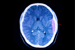  CT scan of the brain of a traffic accident patient showing large epidural hemorrhage and blood clot in his left cerebral hemisphere