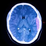  CT scan of the brain of a traffic accident patient showing large epidural hemorrhage and blood clot in his left cerebral hemisphere