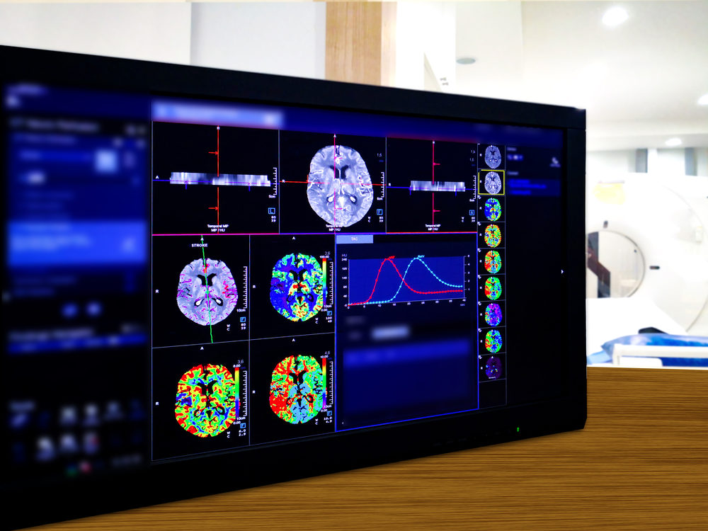 I Sustained a Brain Injury—What Kinds of Damages Can I Seek? Brain Perfusion or CT scan of Blood flow in the brain 3d rendering image on the screen with CT Scan room.