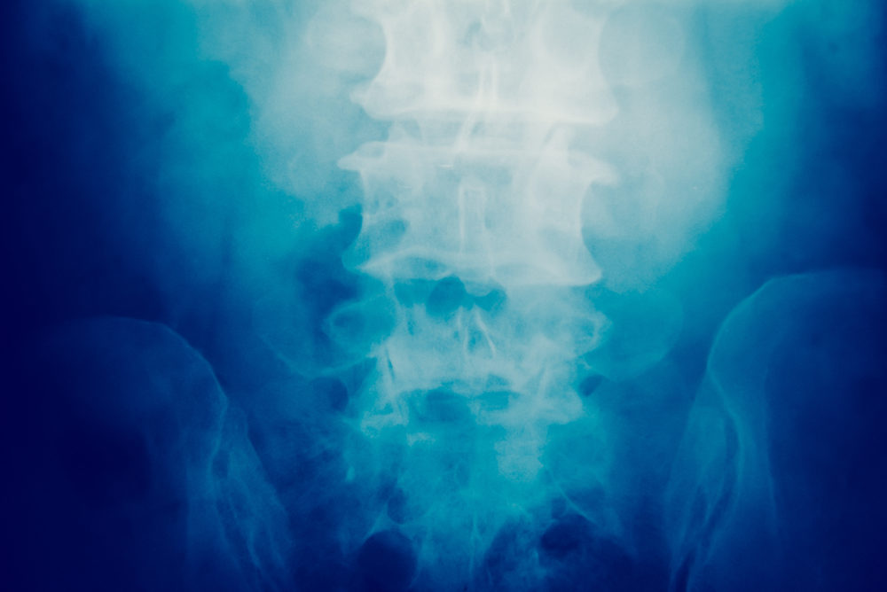 Close up spinal cord bone x-ray