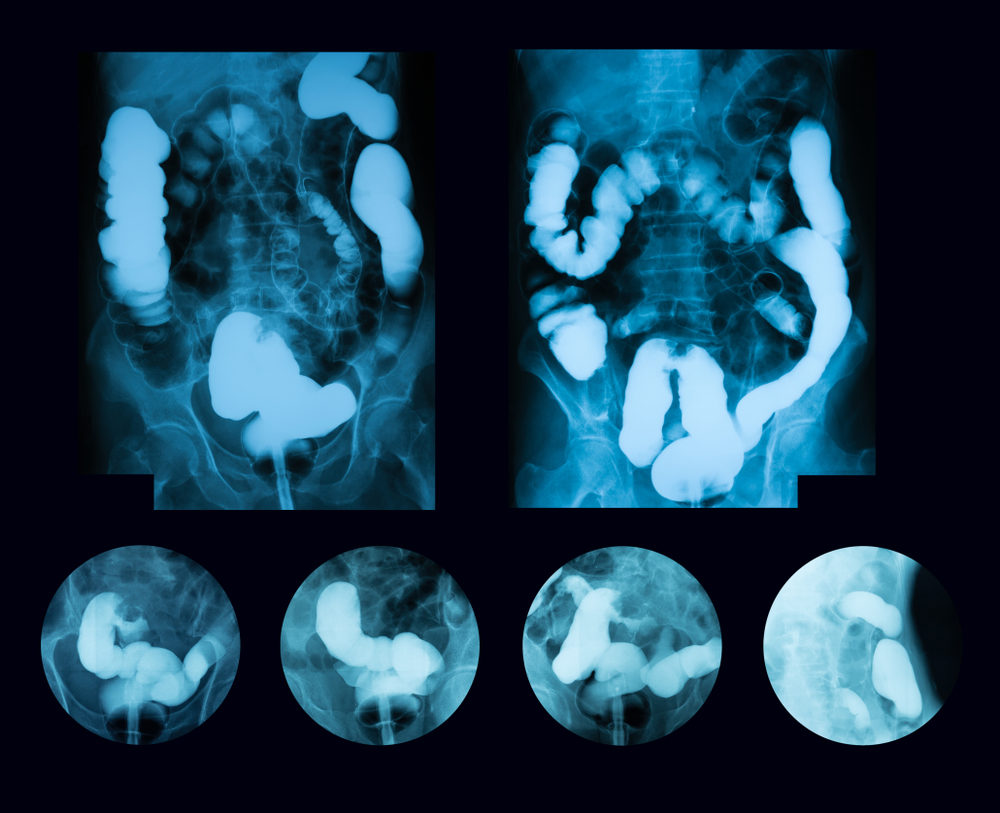 Barium x-ray showing signs of colon cancer