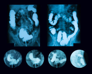 Barium x-ray showing signs of colon cancer