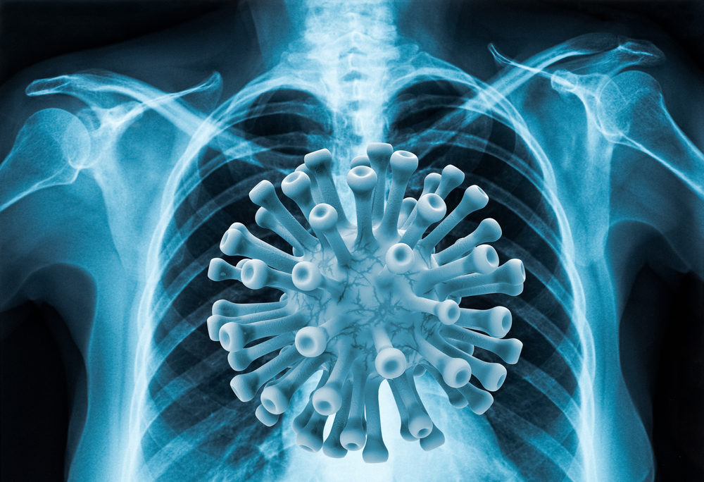 Coronavirus disease COVID-19 virus infection in human lungs xray