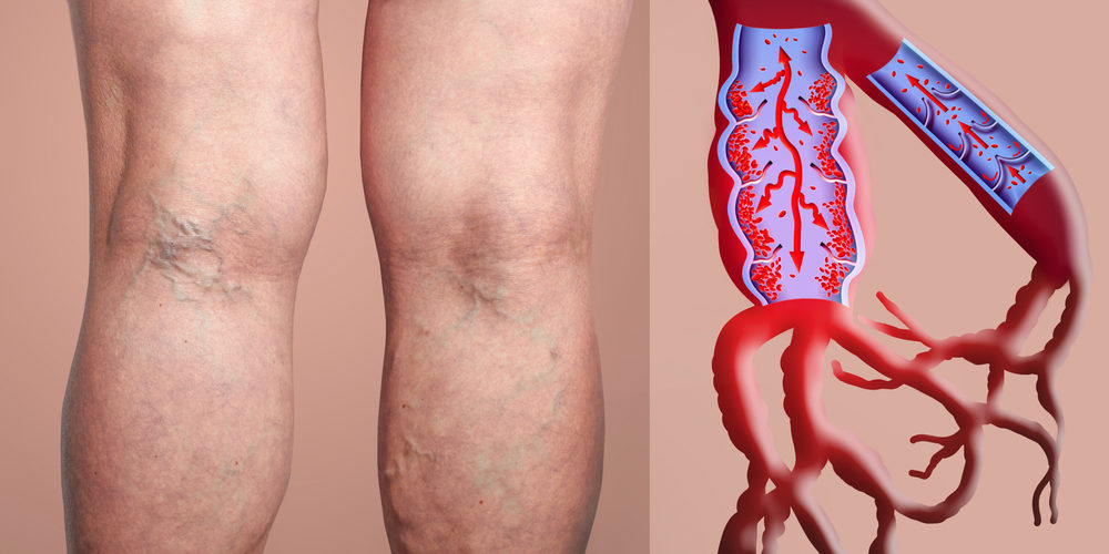 Varicose veins on a female senior legs.