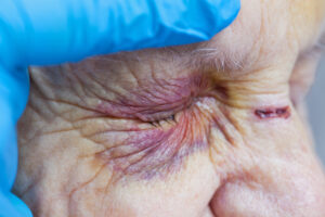 Close up picture of an elderly woman's injured eye and nurse's fingers