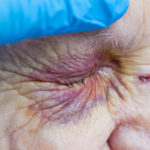 Close up picture of an elderly woman's injured eye and nurse's fingers