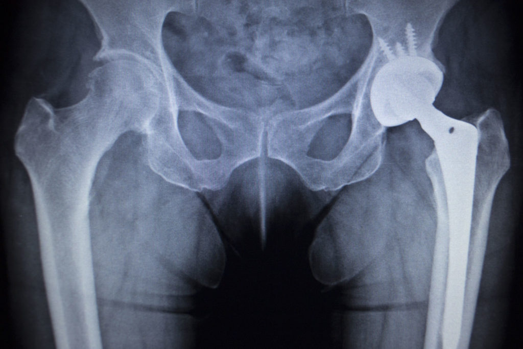 X-ray image of a metal hip implant in a patient