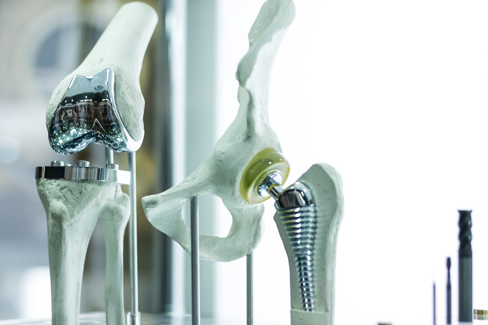 Exactech Hip and Knee Recall Lawsuits Coordinated in Brooklyn, New York and Gainesville, Florida Knee and hip prosthesis