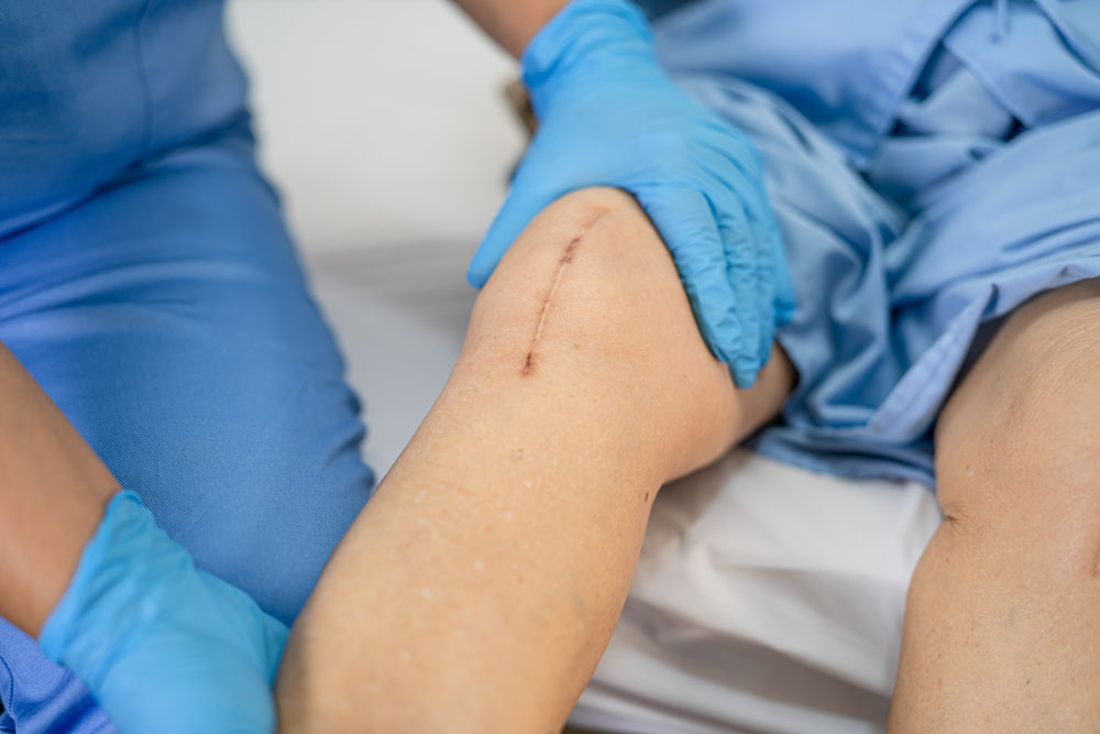 After Going Through Premature Revision Surgery, Florida Woman Sues Exactech woman patient show her scars surgical total knee joint replacement