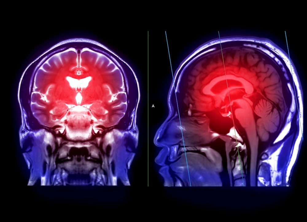 MRI brain scan to detect a variety of conditions of the brain such as cysts, tumors, bleeding and stroke diseases.