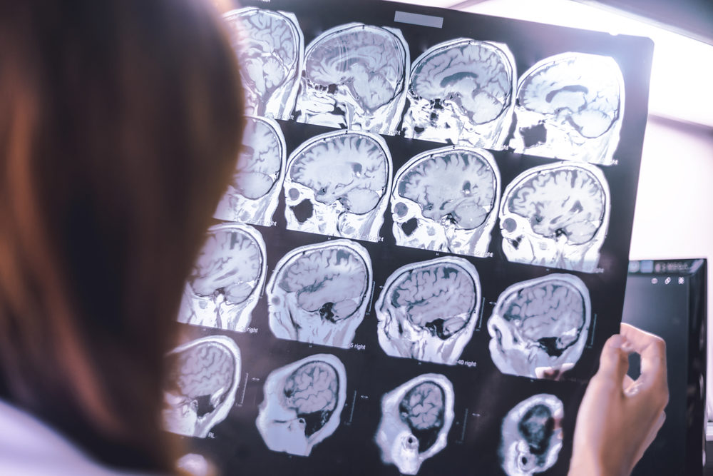 frontal lobe atrophy on MRI film probably Frontotemporal Dementia