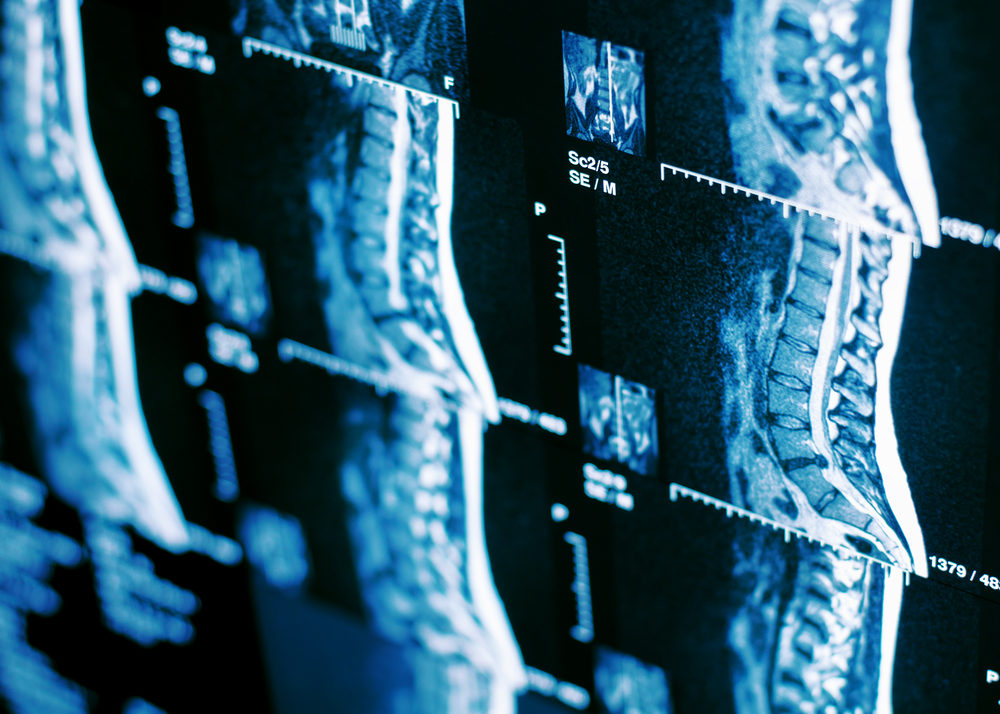 What Kinds of Damages Can You Seek After Sustaining an SCI? MRI scan of human spine