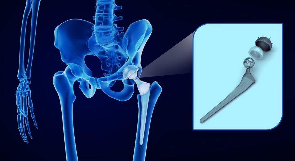 A metal hip implant seen via an x-ray image (3d rendering)