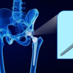 A metal hip implant seen via an x-ray image (3d rendering)