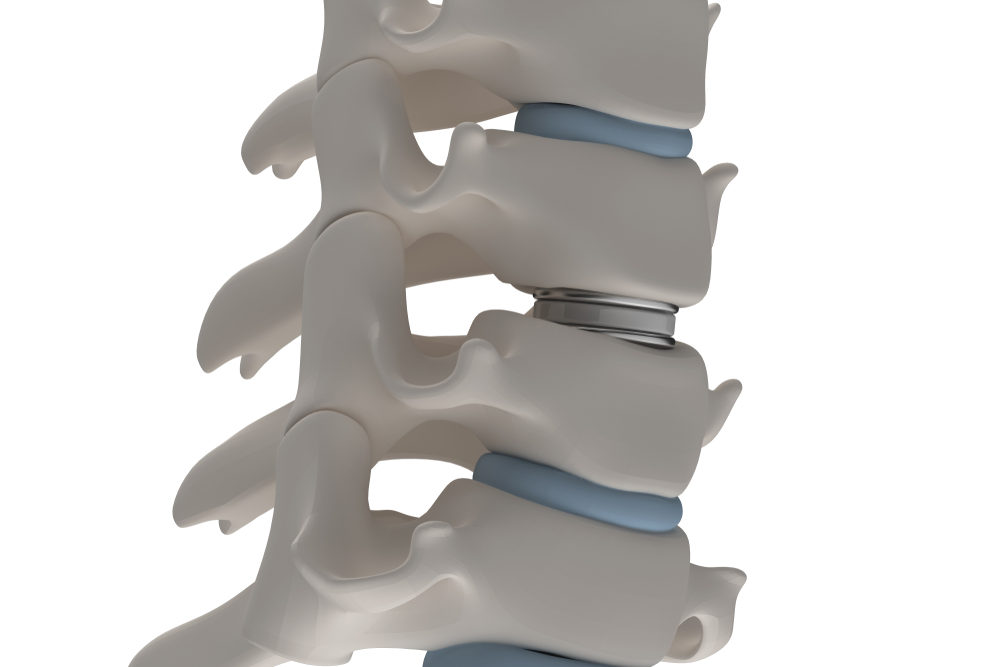 MAGEC Spinal Rods Recalled for Potential Breakage, Metal Corrosion