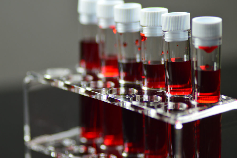 New Blood Test a Safer Alternative to Heart Biopsy