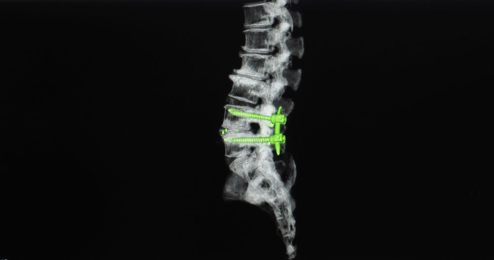 Study Shows Excessive Wear in Explanted Nuvasive MAGEC Rods Study Shows Excessive Wear in Explanted Nuvasive MAGEC Rods