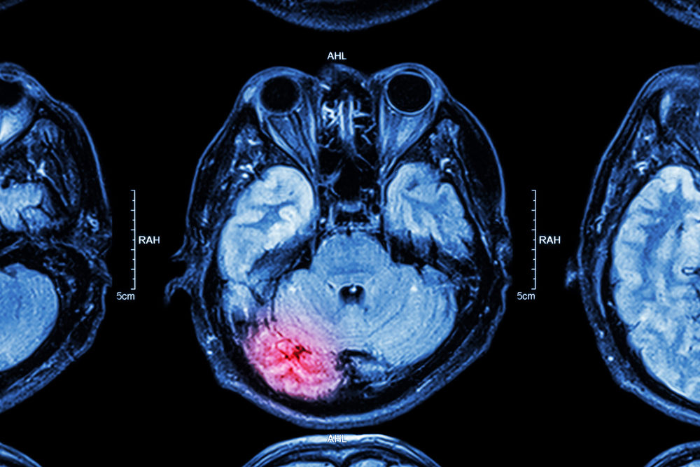 MRI scan of brain injury