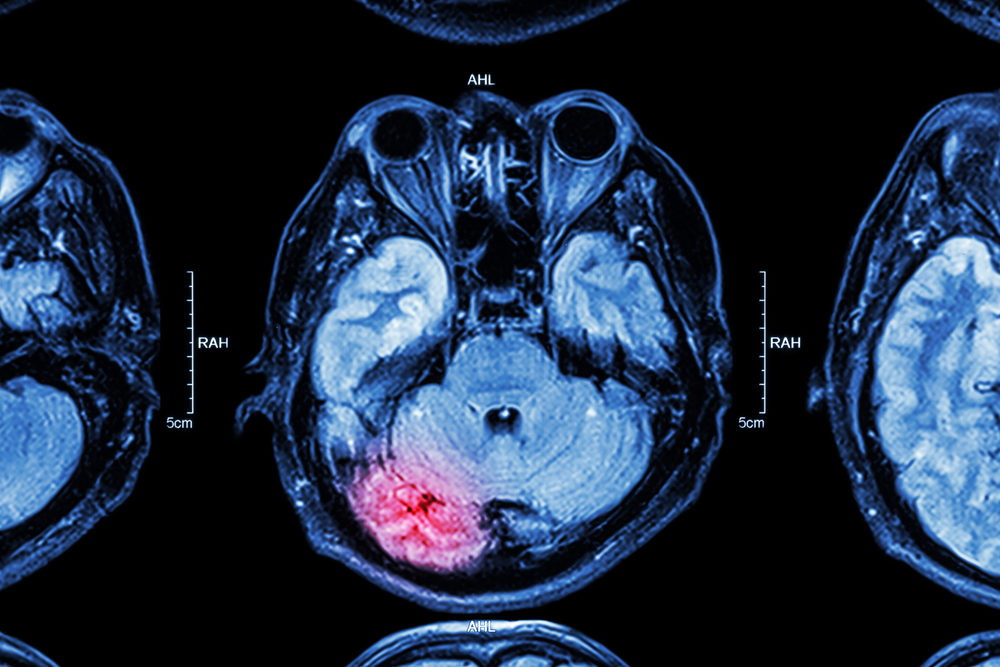 Type of Brain Injury From A Detroit Automobile Crash: What You Need To Know MRI scan of brain injury