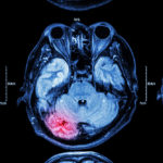MRI scan of brain injury