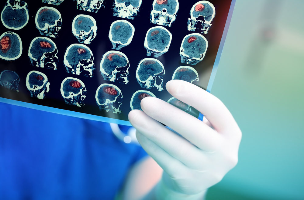 Traumatic Brain Injuries: Potential New Treatment Creates Hope for the Future