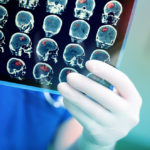 Traumatic Brain Injuries: Potential New Treatment Creates Hope for the Future