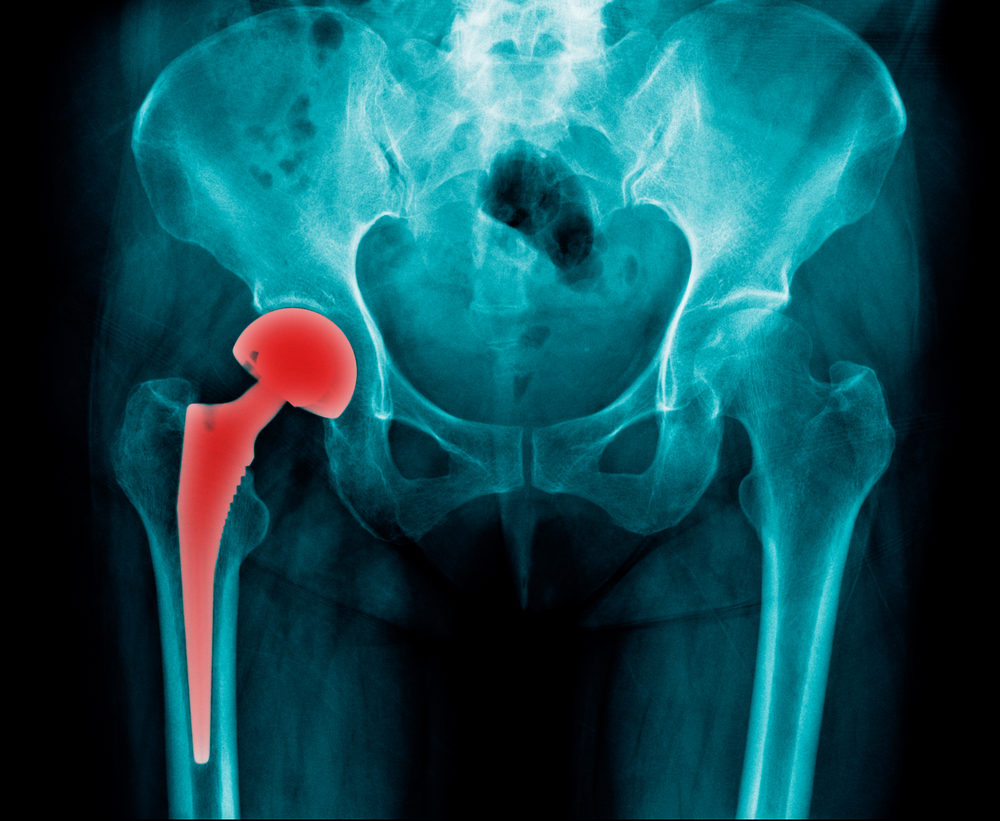 A metal hip implant seen via an x-ray image 