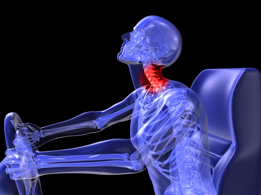 Cervical Connective Tissue Injury (a.k.a. “Whiplash,” “Cervical Soft Tissue Injury,” and “Cervical Strain and/or Sprain”)