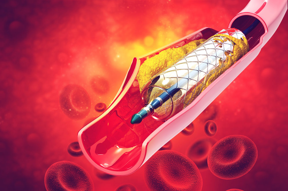 3d rendering of stent angioplasty in an artery