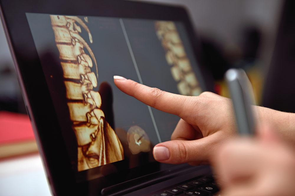 How Medical Illustrations Can Benefit Your Personal Injury Case Hand pointing on screen with X-rays of the spine.
