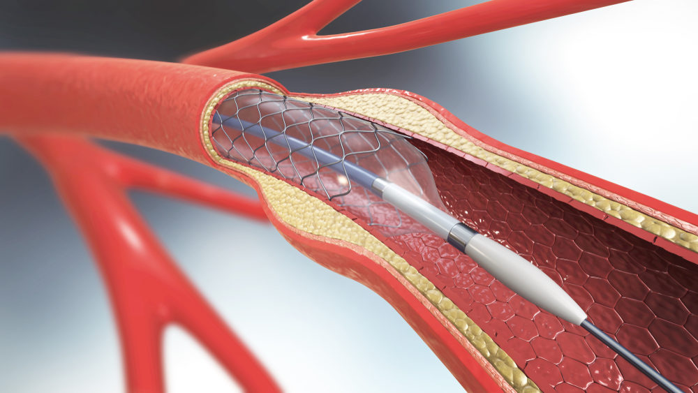 3d illustration of stent implantation for supporting blood circulation into blood vessels