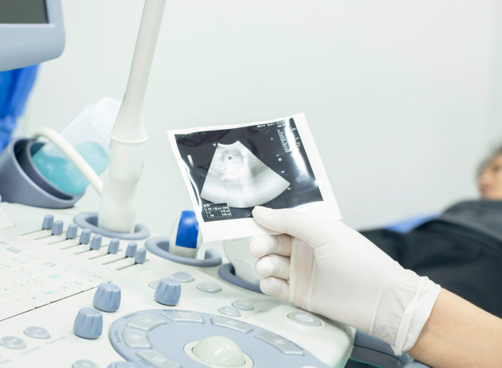 The women wore gloves are watching the ultrasound abdomen of a female patient lying on a bed of the hospital.