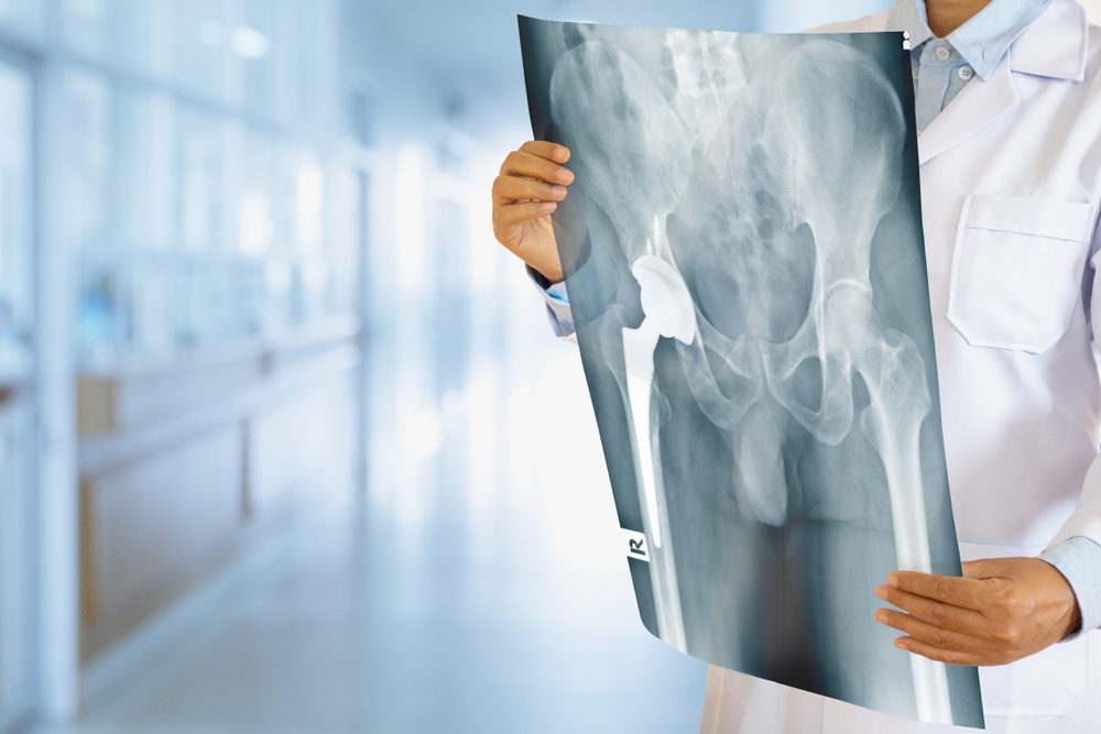 Optetrak, Trulliant and Vantage : Recall on the Exactech Knee, Ankle and Hip Replacements Doctor looking at total hip replacement X-ray film with blurred hospital background.