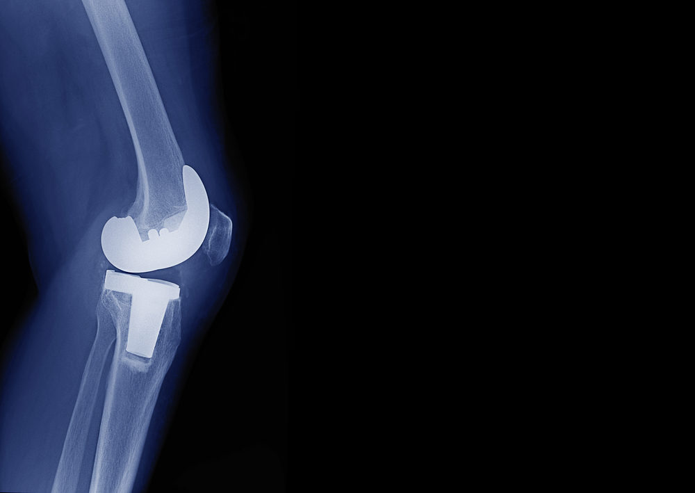 x-ray image of total knee arthroplasty / total knee replacement side view show metallic joint implant in bone