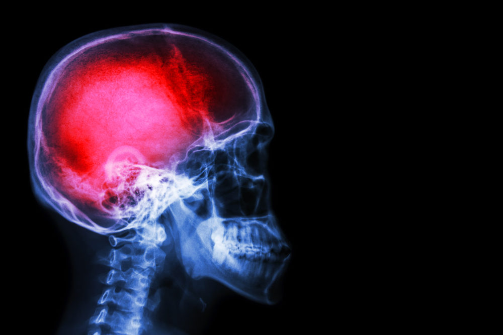 X-ray skull & cervical spine (lateral) with "Stroke"