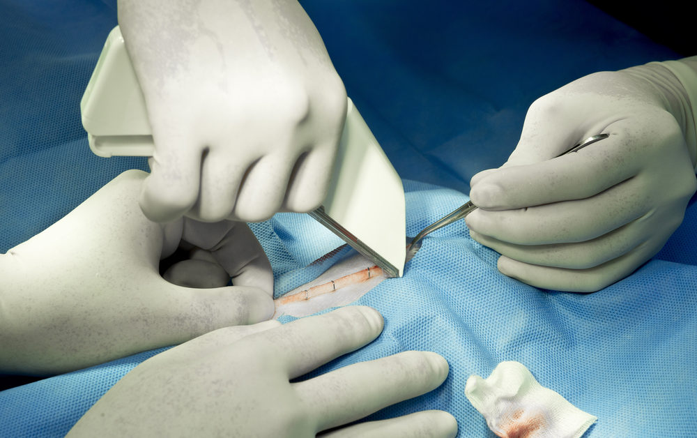 surgical stapler suturing a patient in surgery