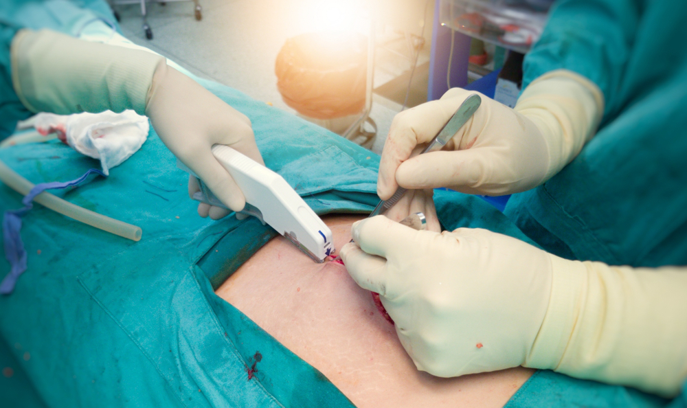 $In the hospital operating room,surgical team,surgeon and scrubnurses suture wound with modern instrument, stapler after successful surgery.