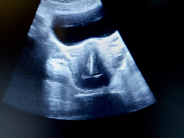 normal situ iuntra uterine device in retroverted uterus by ultrasound scan