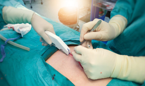 In the hospital operating room,surgical team,surgeon and scrubnurses suture wound with modern instrument, stapler after successful surgery.